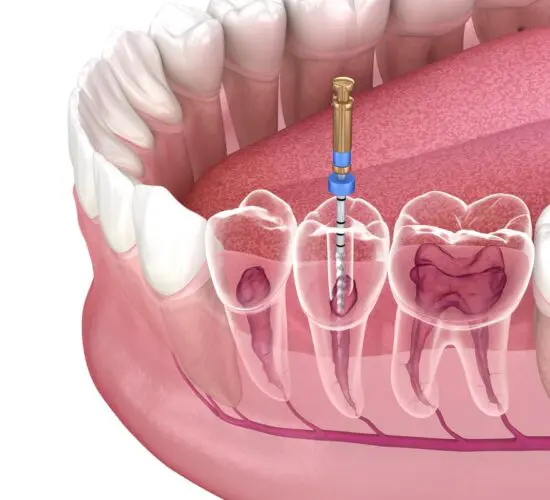 Root Canal Treatment
