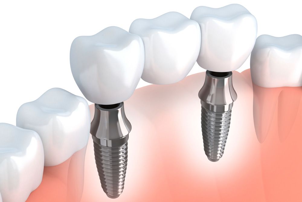 Implant-Supported Bridges