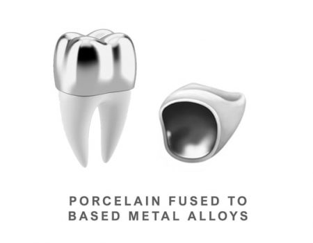 porcelain-fused-metal-crowns