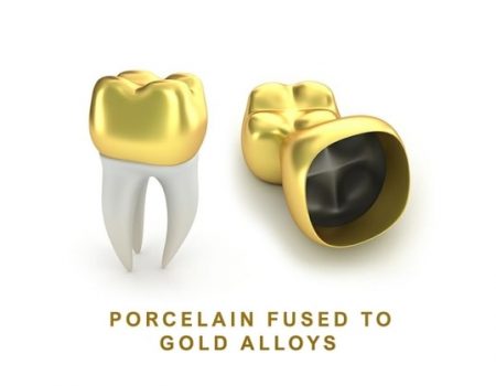 Porcelain-Fused-to-Gold-Alloys-