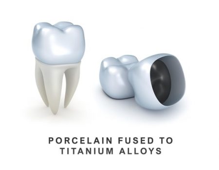 porcelain-fused-metal-crowns