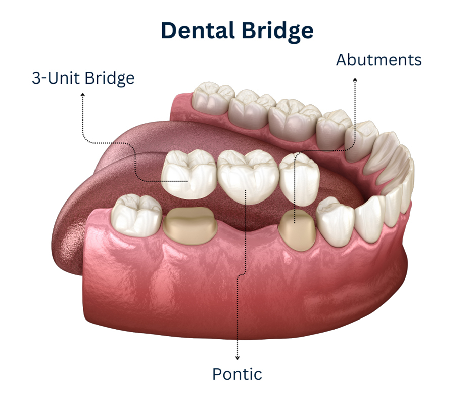 dental-crowns-bridges