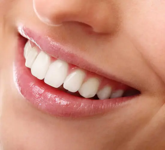 Teeth Bleaching