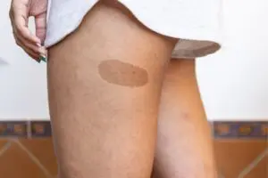 safe to cut off birthmark