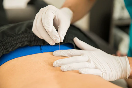 How Long Does Dry Needling Take?