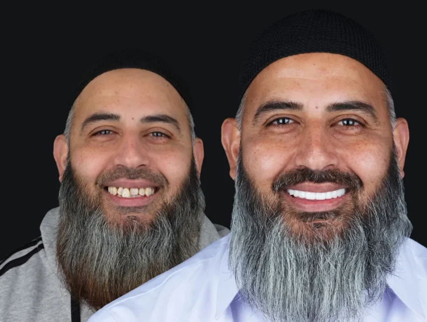 Is Composite Veneers Haram?