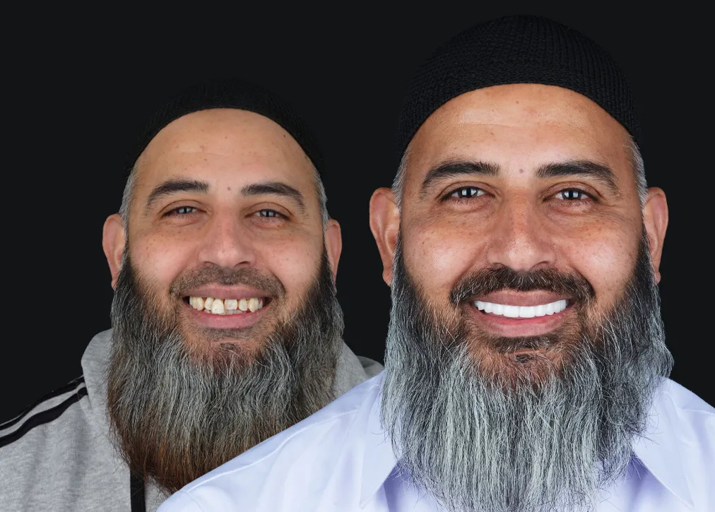 Is Composite Veneers Haram?