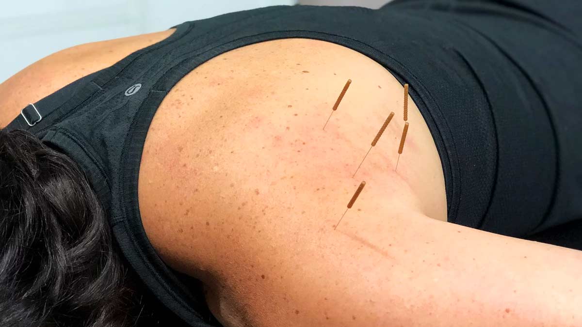 How Often Should Dry Needling Be Done?