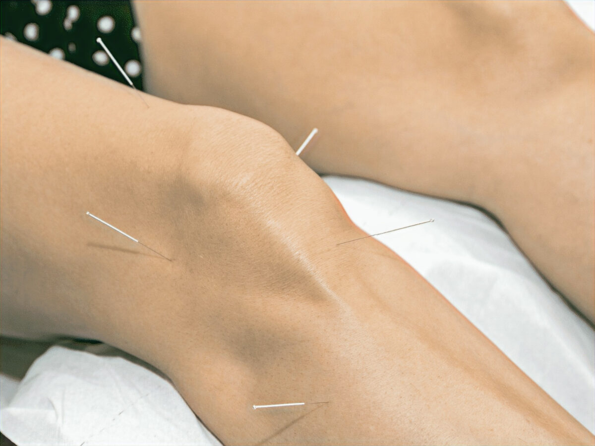 How Does Dry Needling Work?