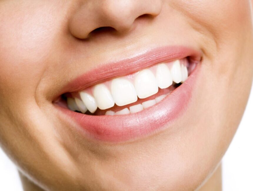 How Much Does Teeth Whitening Cost in Dubai