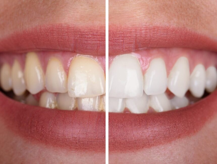 How Long Does Professional Teeth Whitening Last?