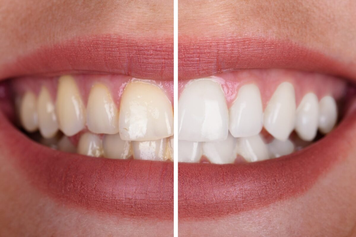 How Long Does Professional Teeth Whitening Last?