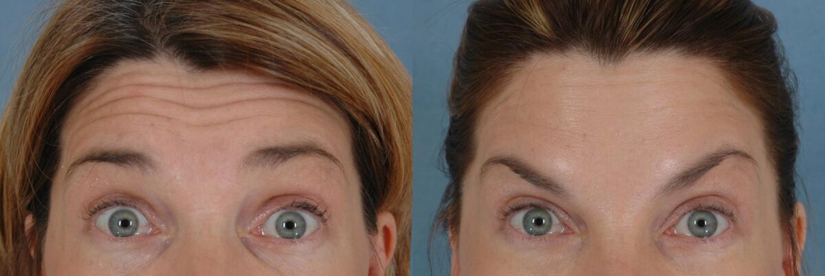 How Long Does Botox Last?