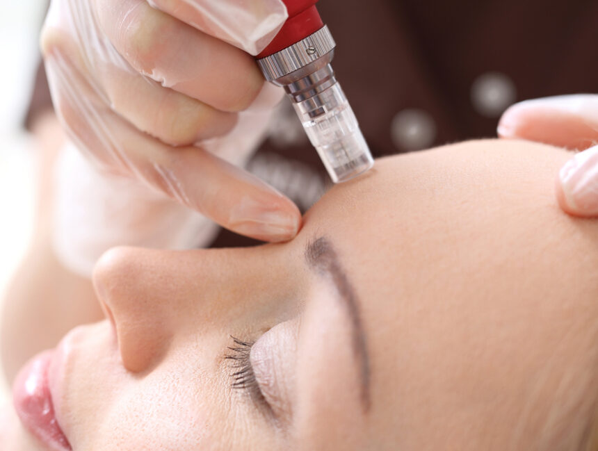 How Often Can You Do Mesotherapy